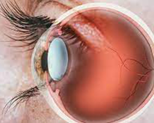 Arunodaya Eye Clinic provides best Retina Treatment in Wakad, Pune, its one of Pune's best retina clinic led by Dr. Anuprita Gandhi Bhatt, Opthamologist in Pune